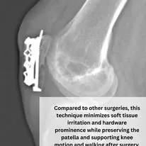 Lateral knee X-ray showing surgical hardware and patella alignment after surgery