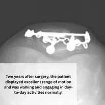 X-ray showing surgical plate and screws in foot or ankle